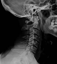 radiologia_cervicale