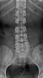 radiologia_lombare